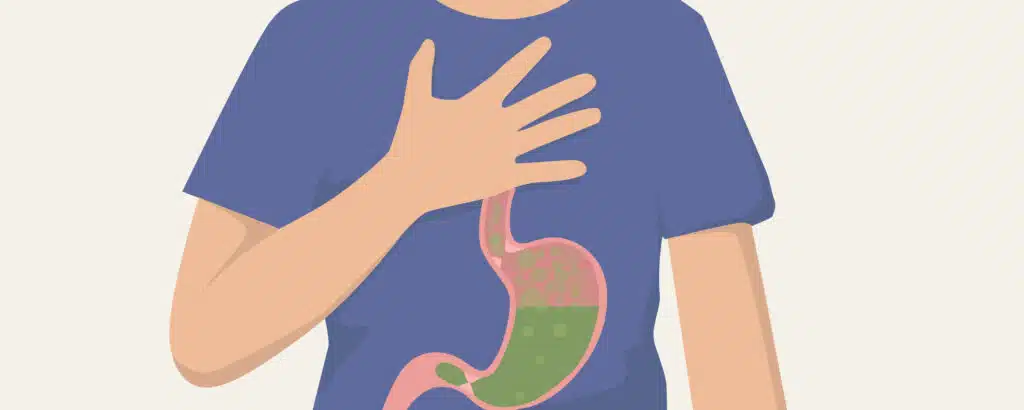 Bei Sodbrennen können verschiedene Tipps unterstützen.