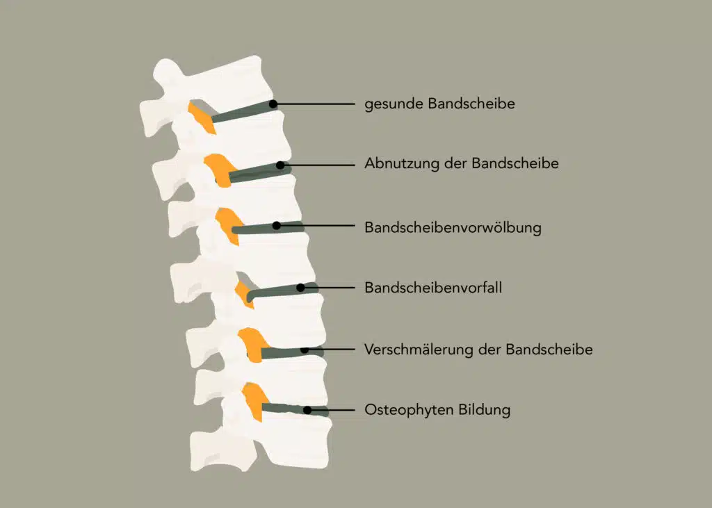 Bandscheiben im Vergleich am Beispiel einer Wirbelsäule