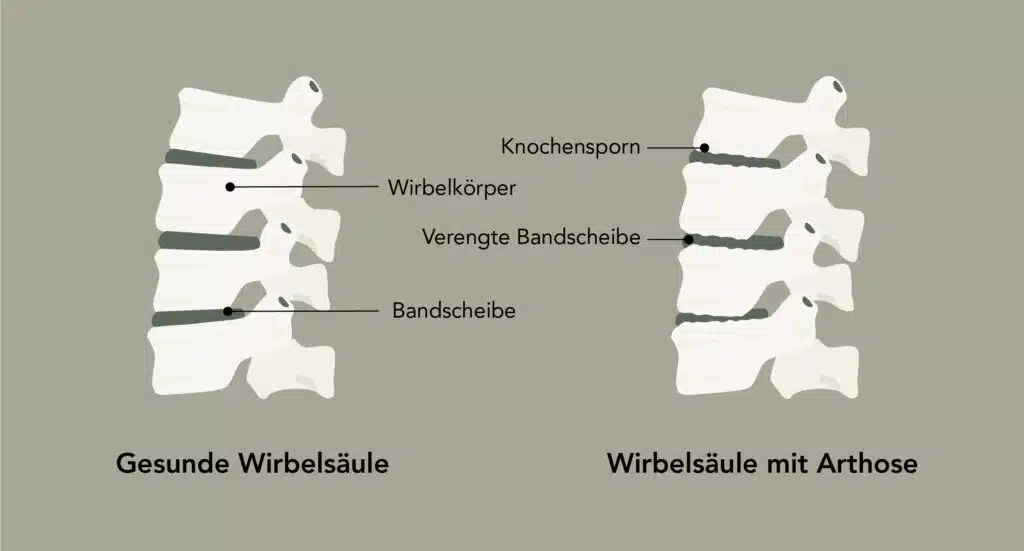 Vergleich zwischen einer an Spondylose erkrankten Wirbelsäule und einer gesunden Wirbelsäule