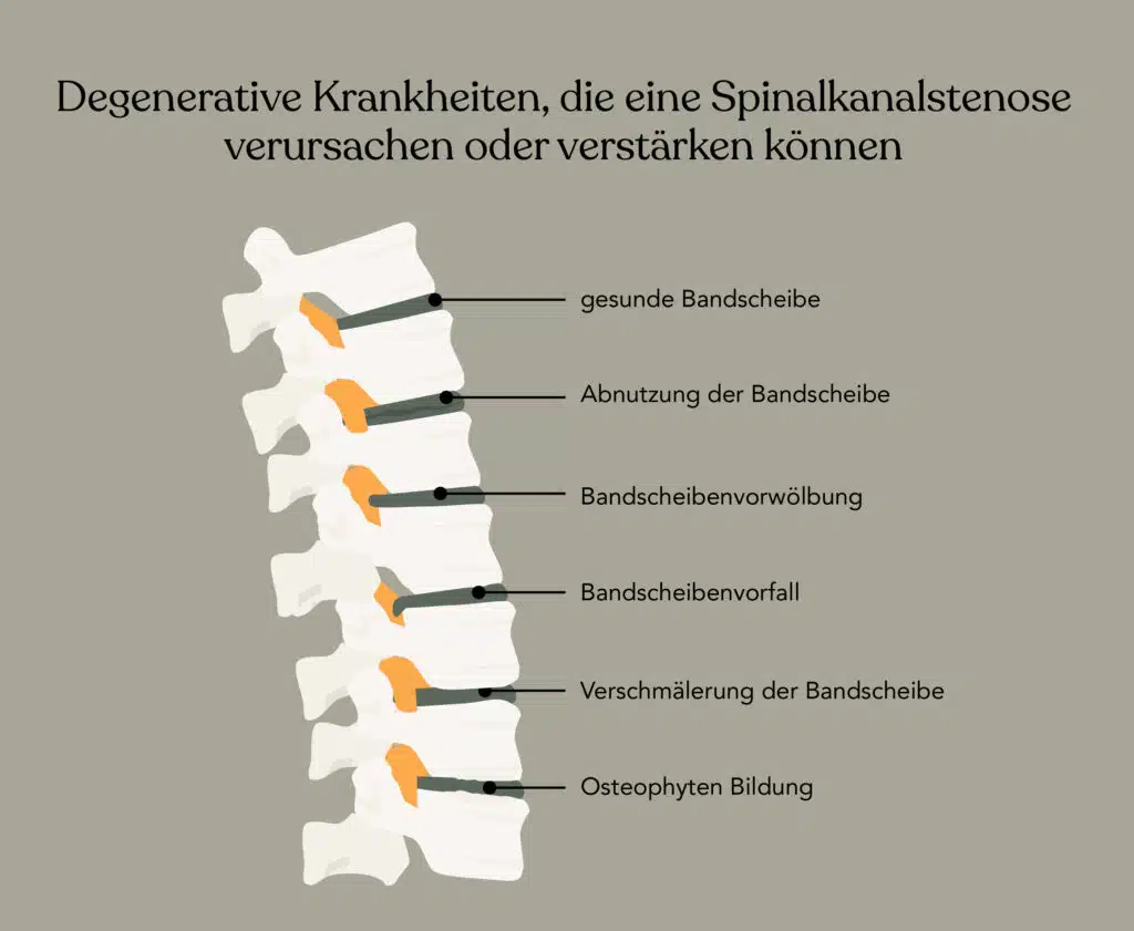 Degenerative Krankheiten, die eine Spinalkanalstenose verursachen oder verstärken können.